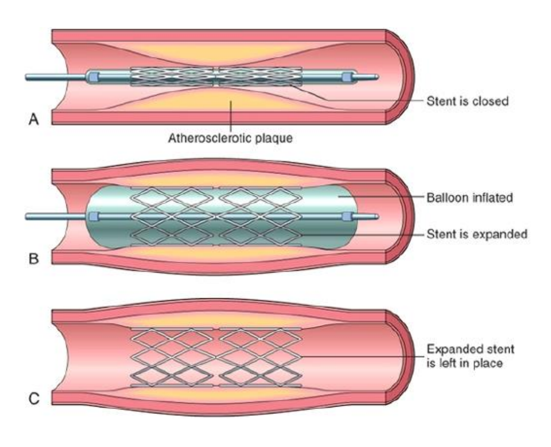 Free Angioplasty (PTCR) In Amravati