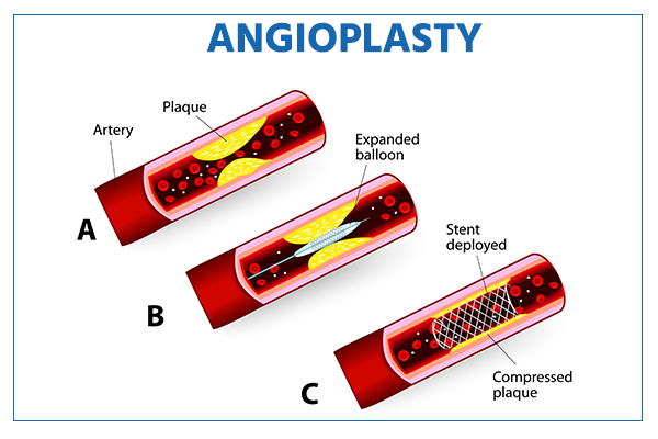 Free Angioplasty (PTCR) In Jabalpur