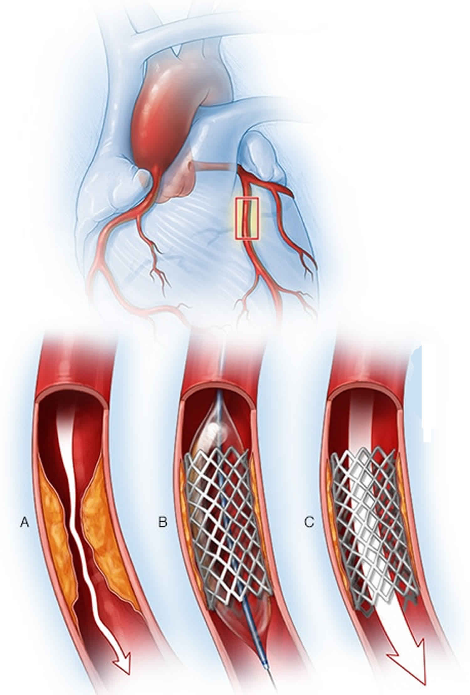 Free Angioplasty (PTCR) In Nagpur