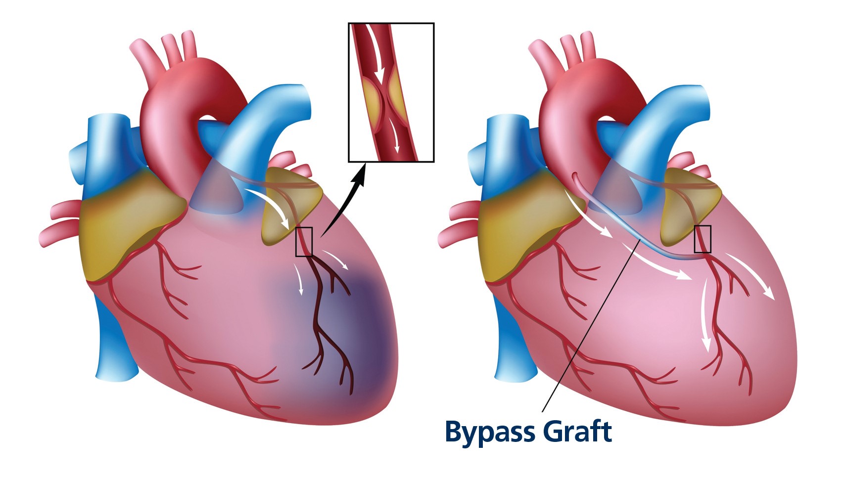 Free Bypass (CABG) In Amravati