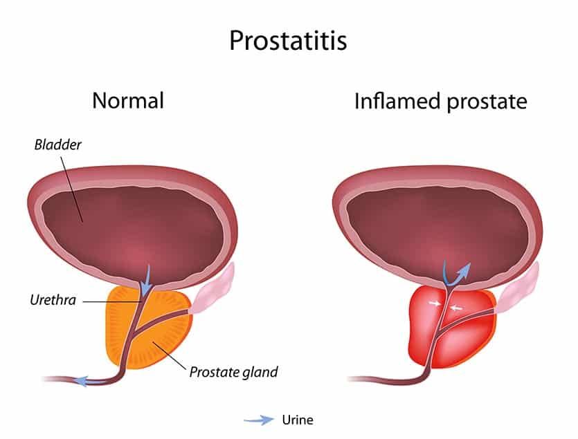 Free Prostate Operation In Amravati