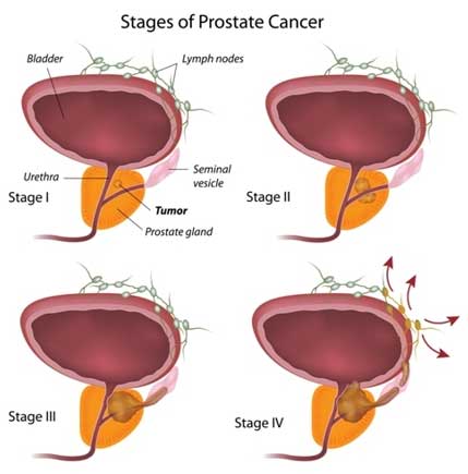 Free Prostate Operation In Jabalpur