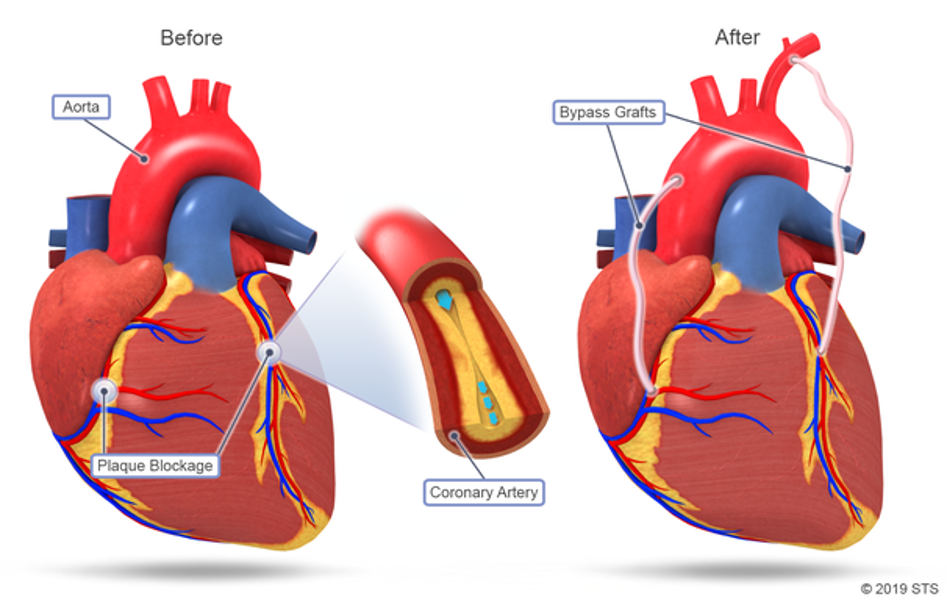 bypass-grafting-after-before