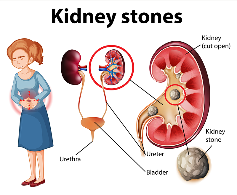 kiendy-stone