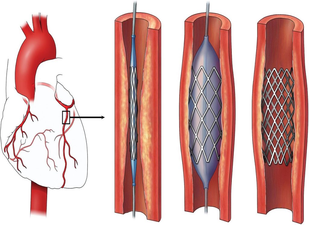 Angioplasty under MJPJAY